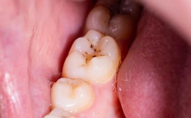 Adeus, cáries? Um novo gel pode regenerar o esmalte dos dentes